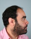 Before Hair Transplant&nbsp;2 Sessions (Areas)